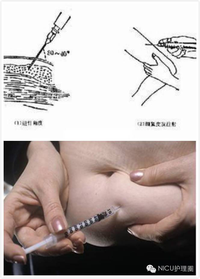 抗血栓药物皮下注射方法