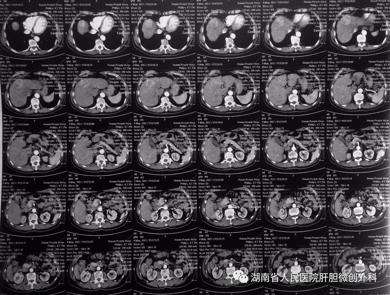 pringle阻斷尾側入路熒光顯影技術下腹腔鏡ⅣaⅧ段巨塊型肝癌切除術