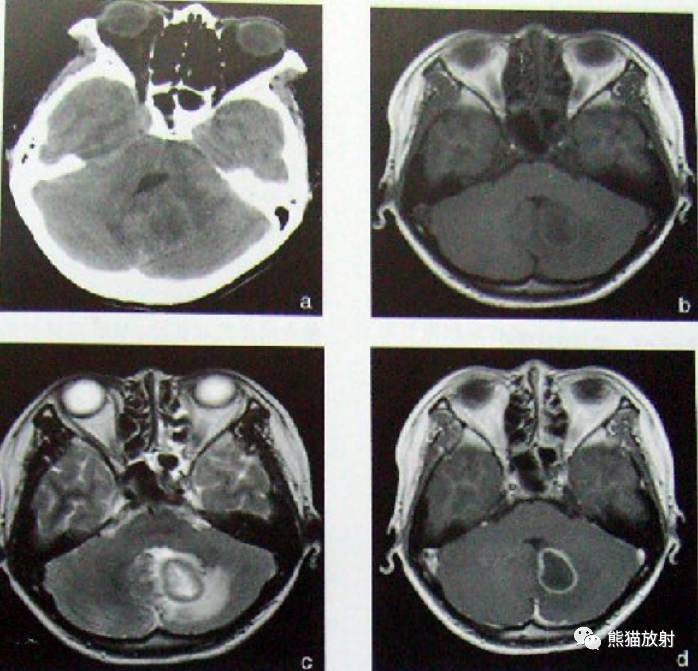 化脓性脑膜炎ct图片
