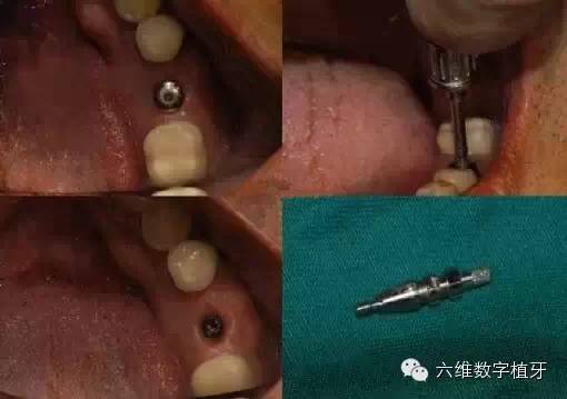 下面几张图是开窗取模"open tray"的过程 第一步,使用螺丝刀将愈合帽