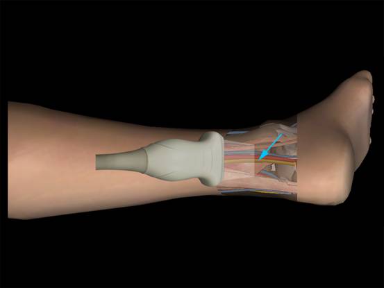 胫骨神经阻滞图片