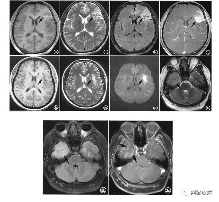 男,22歲.a).t1 wi示左側額葉片狀低信號;b).t2wi上呈高信號;c).