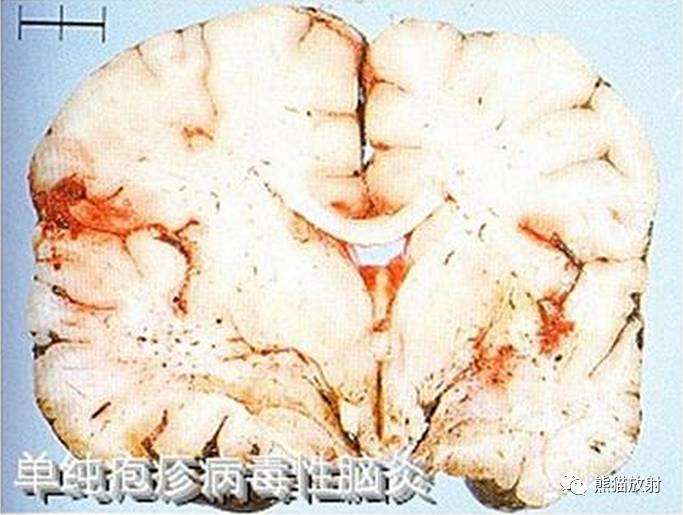 影像病理顱內感染性疾病病毒性腦炎顱內真菌感染