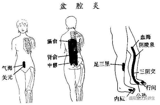 盆骶疼痛指哪里图片图片