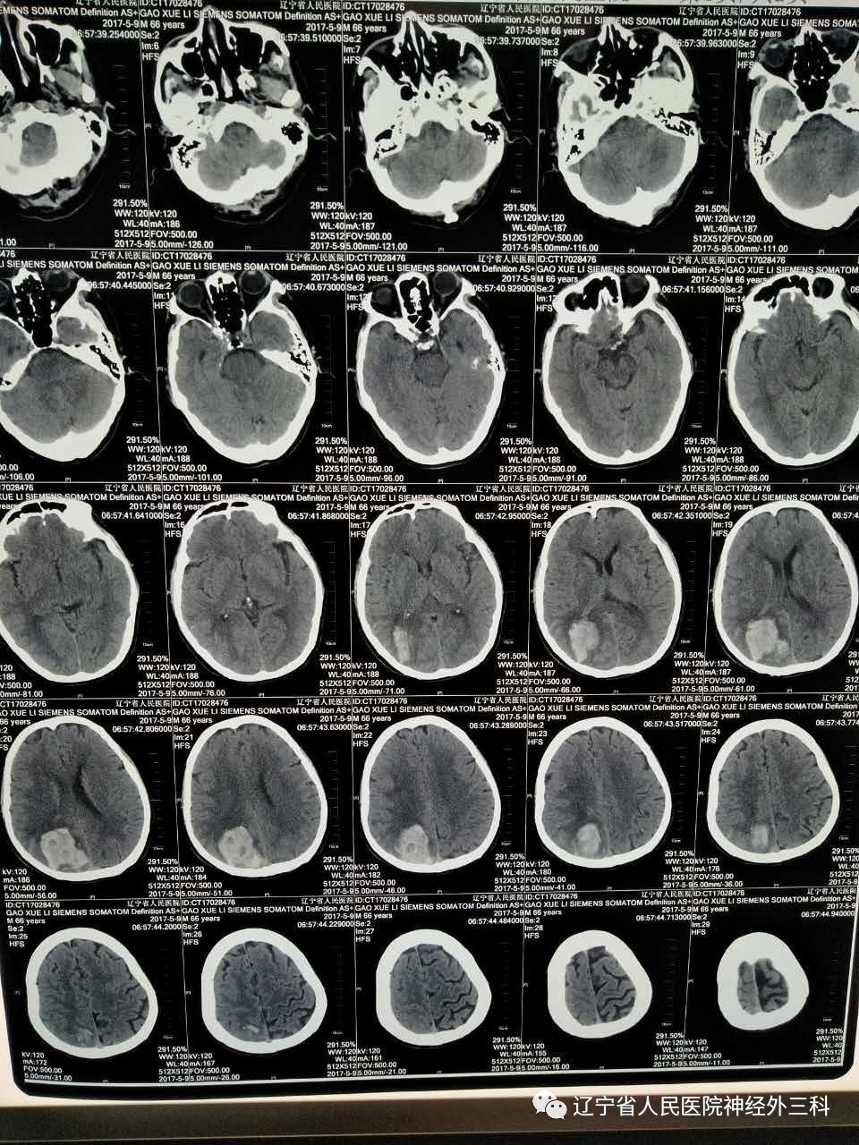 于我院行头部ct检查显示:右侧顶枕页脑出血破入脑室