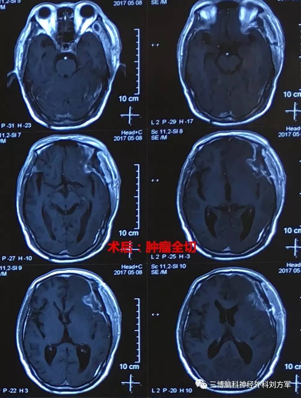 左側翼點開顱蝶骨嵴外側腦膜瘤切除術