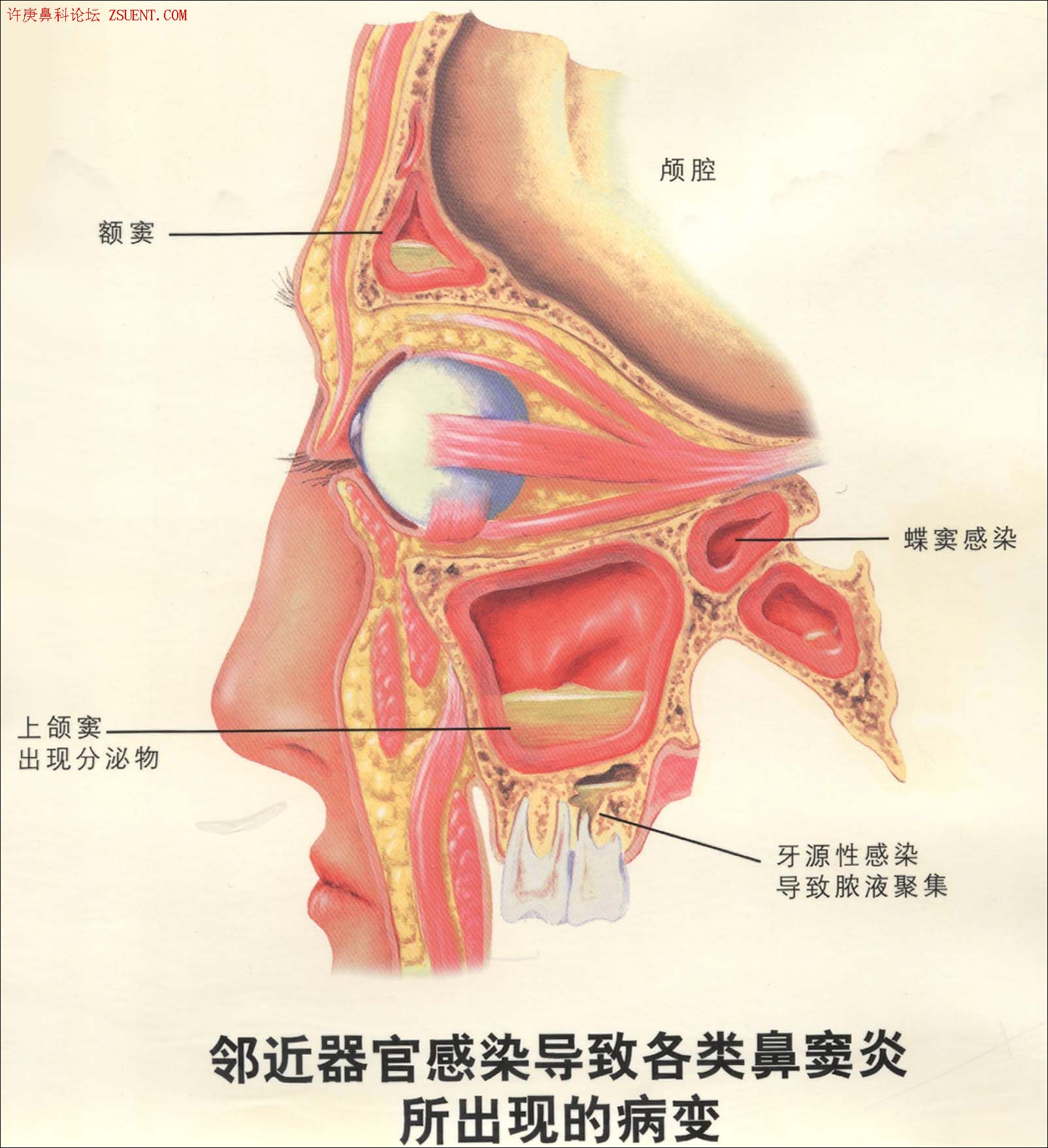 鼻窦炎吃些什么好(慢性鼻炎鼻窦炎吃什么药最好,鼻窦炎形成的原因