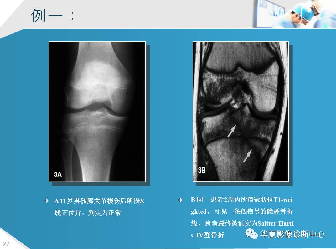 mri检查在骨骺损伤中的应用研研究与进展