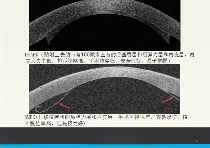 角膜后弹力层脱离图片