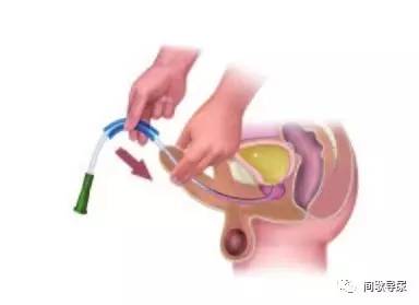 导尿管插入将近一半感觉到有阻力时,将阴茎朝大腿方向缓缓放下,使之与