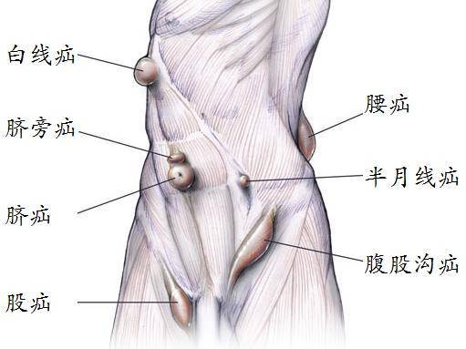 涨知识丨直疝?斜疝?股疝?我到底得的是什么疝?—谈谈小肠气的分类