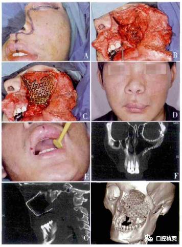 3d打印技術用於鈦網修復全上頜骨缺損6例報道