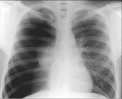 名称:液气胸照片名称:液气胸的x射线表现照片名称:肺内钙化照片名称
