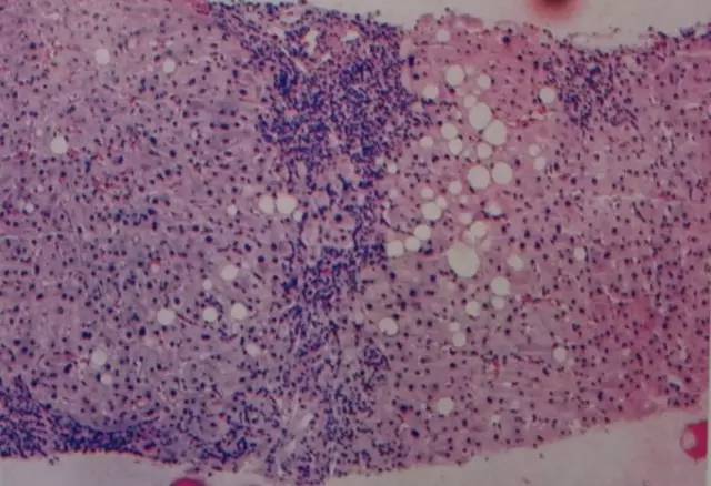 肝小叶失去原有结构并出现桥接坏死:形成透亮水肿的纤维间隔,门管区