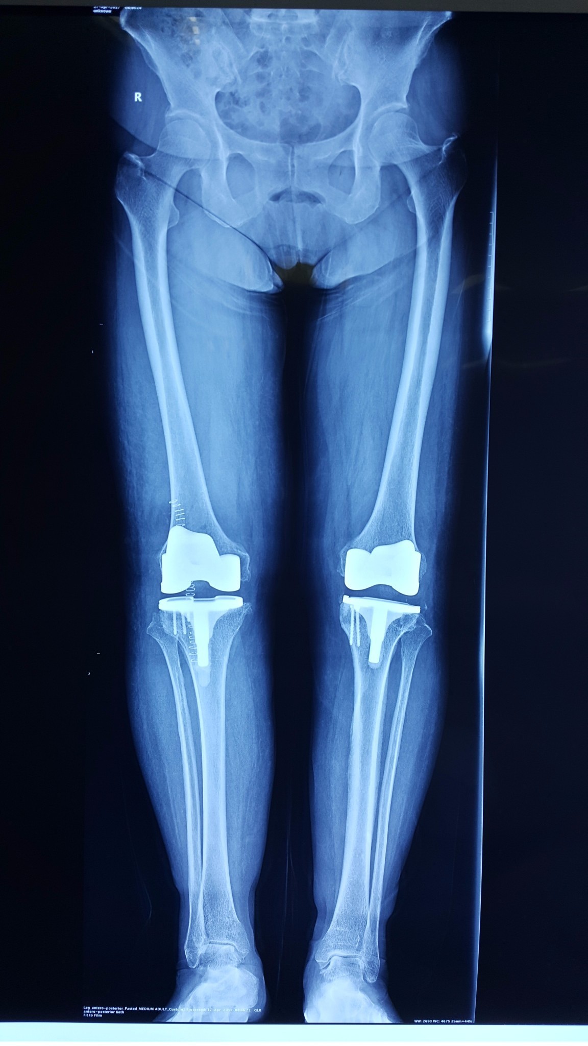病例我院骨外科为吹风膝患者成功实施膝关节表面置换术