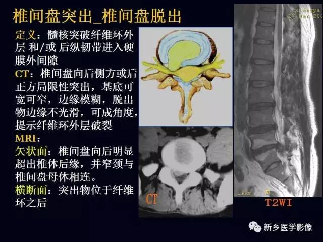 常见不简单丨详解椎间盘突出解剖分型分度