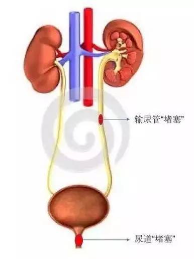 2,尿道(如前列腺增生,結石等)1,輸尿管(如結石等)任何一個地方發生