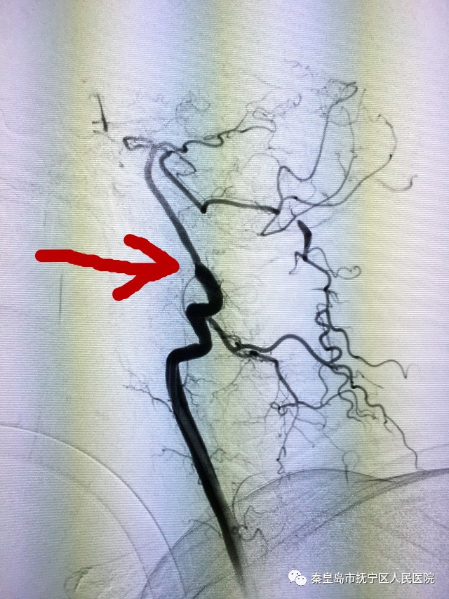 技术︱抚宁区人民医院成功治愈椎基底动脉闭塞,谱写治疗新篇章