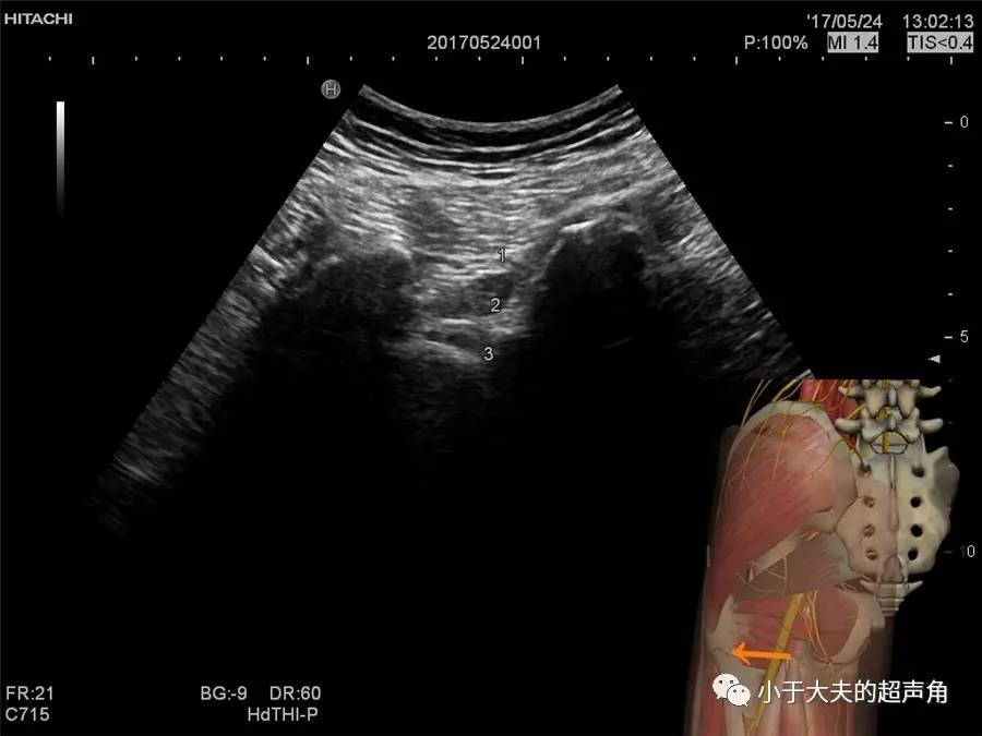 梨状肌综合征超声图片图片