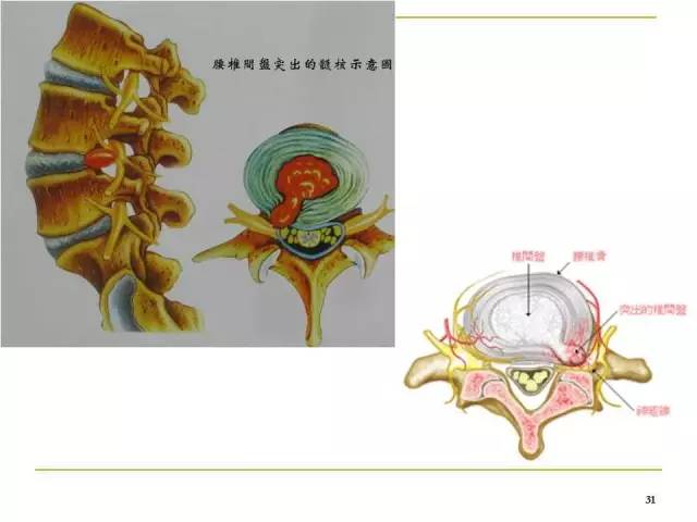 腰椎間孔的解剖與臨床