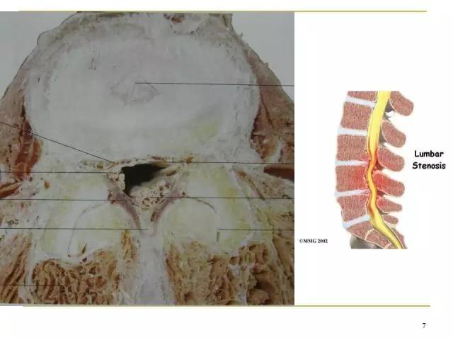 腰椎間孔的解剖與臨床