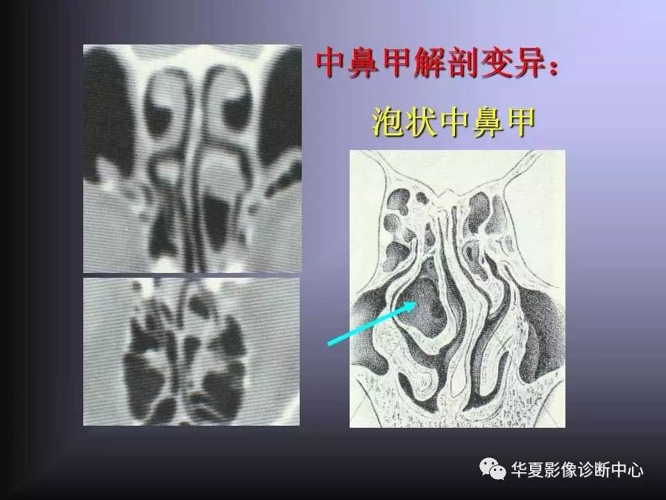 影像基礎鼻腔鼻旁竇的解剖變異