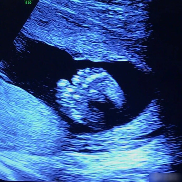 怀孕40天b超图片高清图片