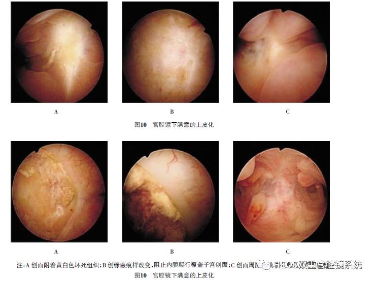 子宫纵隔图片宫腔镜图片