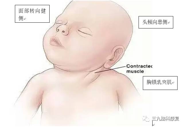 怎么看出婴儿是否斜颈图片