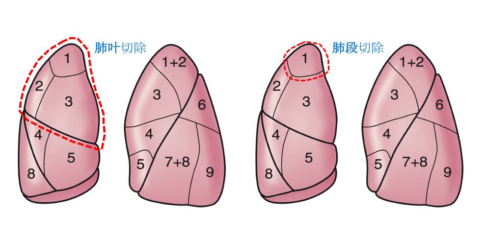 肺段示意图图片