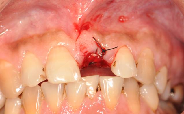 拔牙后牙窝状态图图片