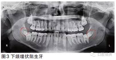 另一類特殊的埋伏牙是年輕的阻生智齒(圖3).