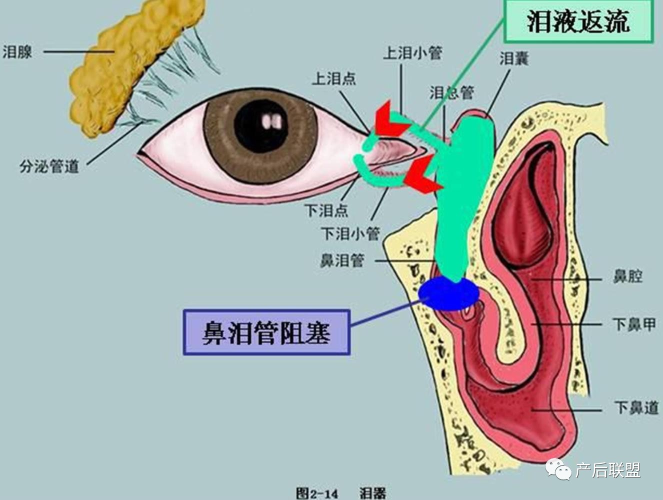 在鼻腔开口处,有种先天性的膜没破开,形成了鼻泪管阻塞,又叫泪囊炎