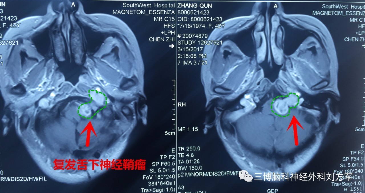 右侧远外侧开颅复发舌下神经鞘瘤切除术