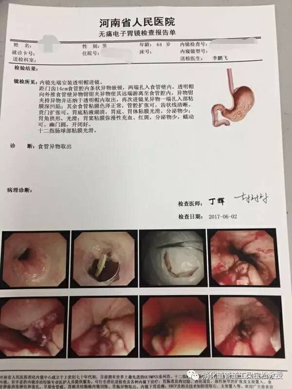 病理报告外院的胃镜检查结果钡餐检查结果外院的上消化道钡餐检查过后