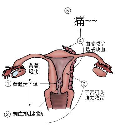 慢性盆腔疼痛位置图片图片