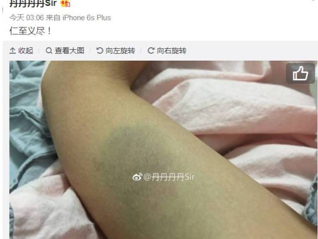 刘一手女友被打图片爆出大腿淤青真狠啊仙洋放话刘一手你来沈阳肯定打