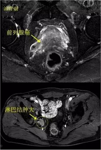 仁濟要聞|仁濟醫院成功實施國內首例機器人熒光顯像輔助下前列腺癌