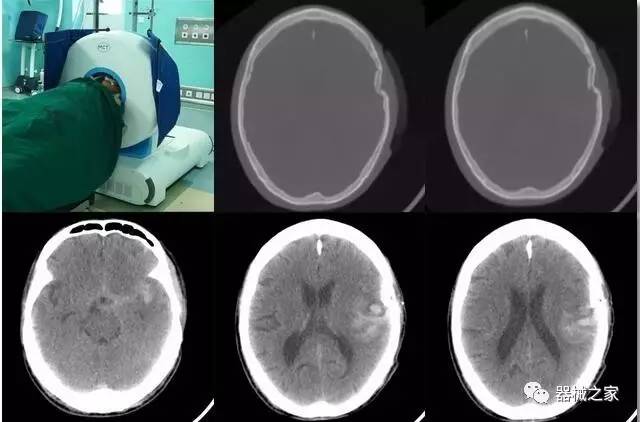 腦科icu腦出血移動ct床旁腦部掃描