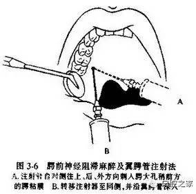 口针疗法图解图片