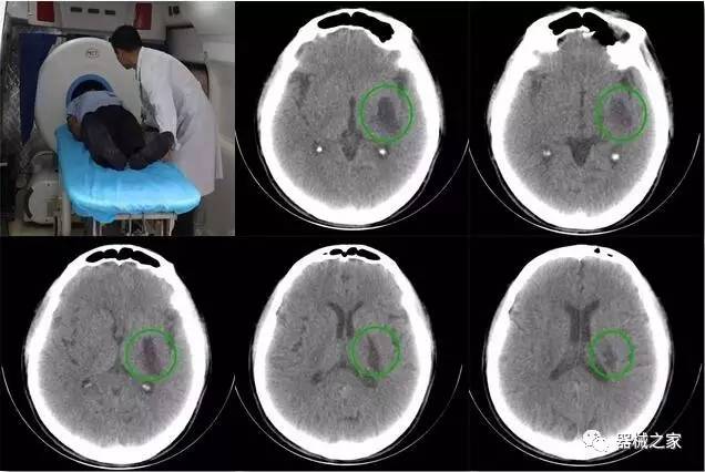 救護車載移動ct陳舊性腦梗塞掃描