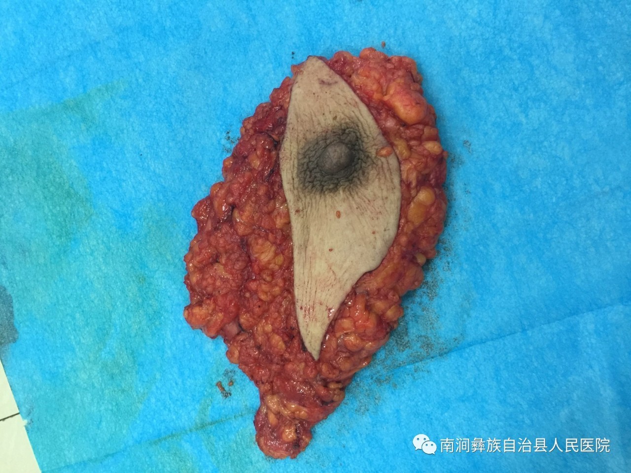乳腺导管瘤手术外观图片