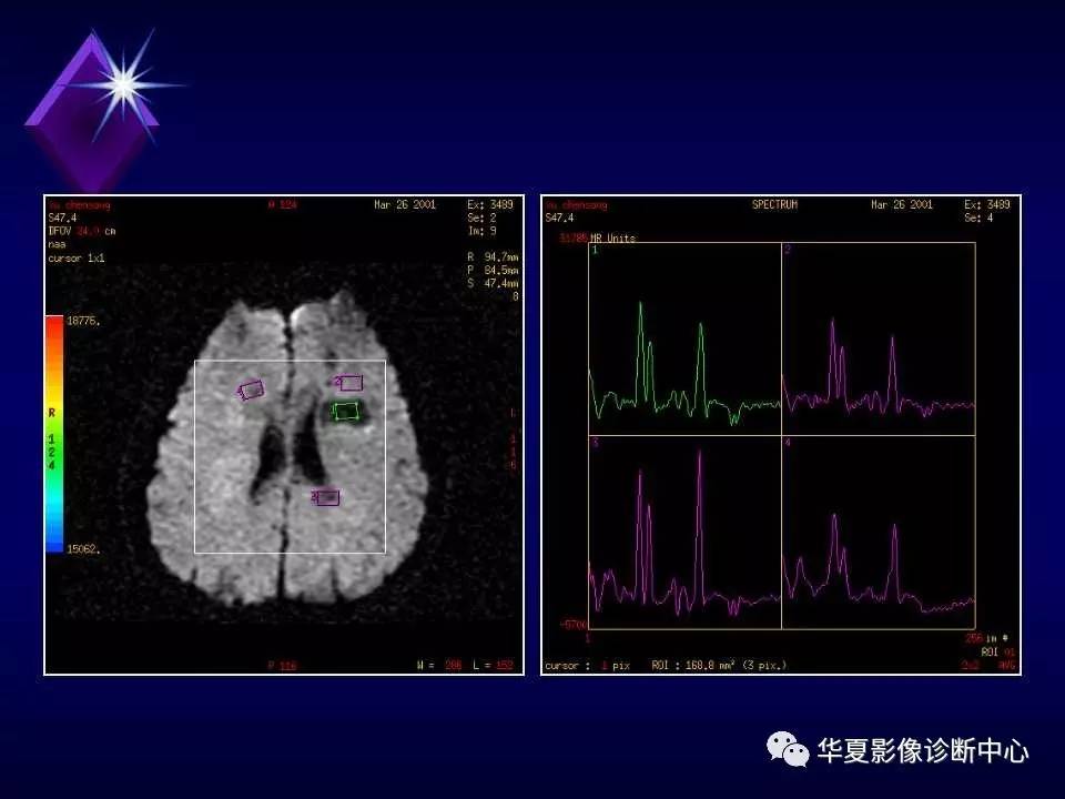 磁共振波譜分析mrs的應用