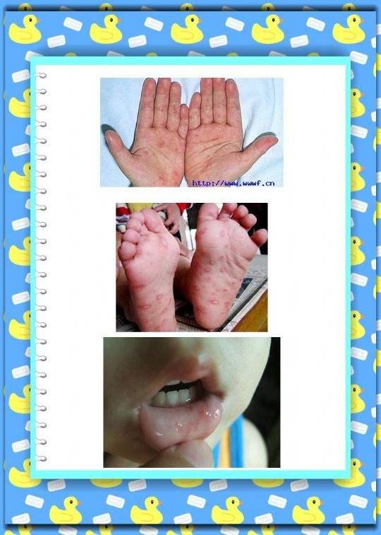 健康 正文 儿童手足口病是以发热,手,足,口腔发有疱疹为特征,由病毒