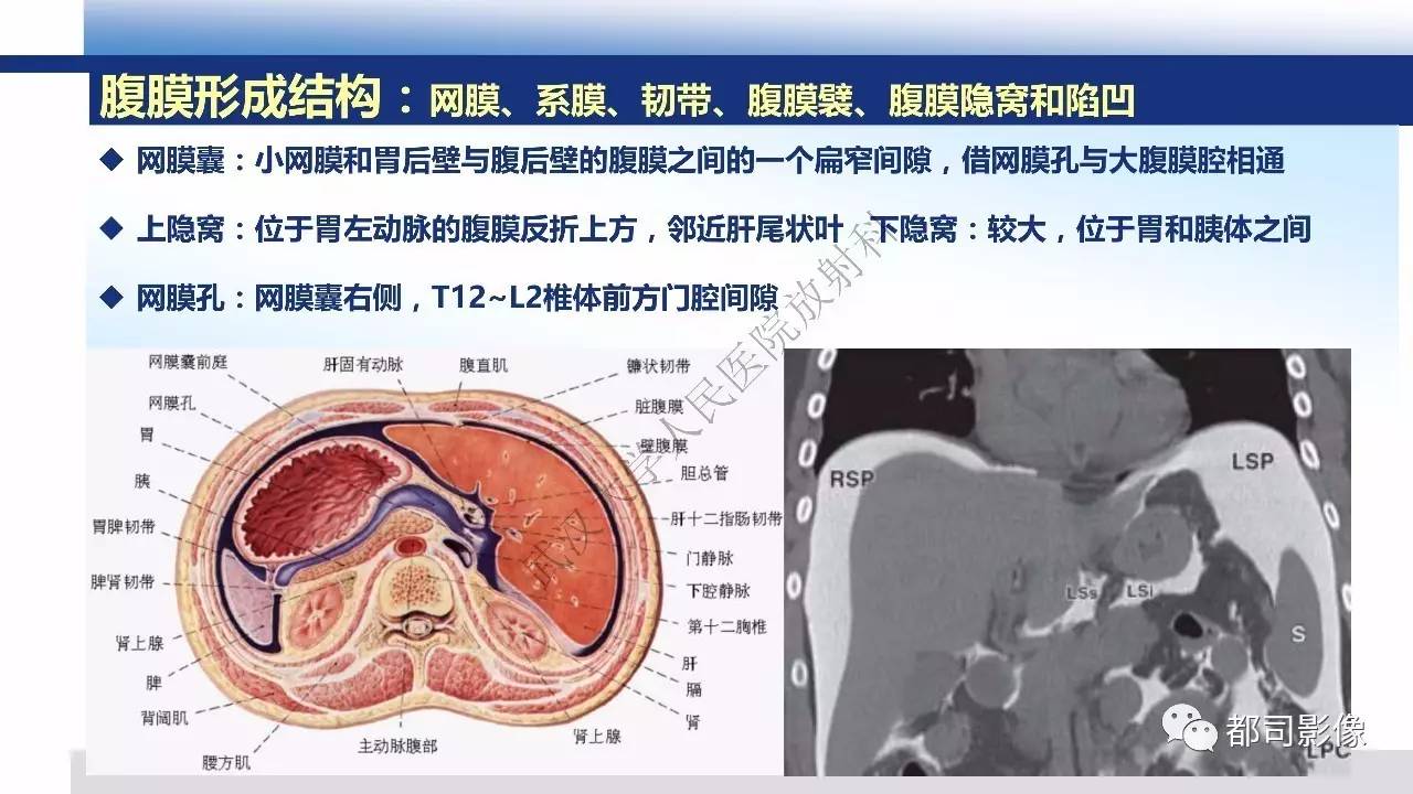 腹膜解剖及炎性病变影像诊断