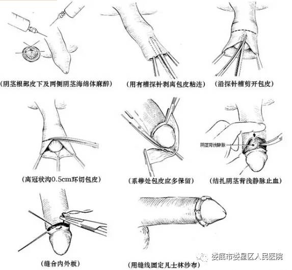 韩式微雕包茎手术图片图片