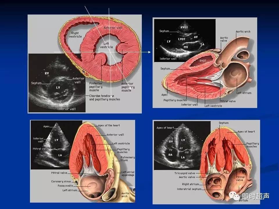 冠状动脉瘘超声诊断ppt图片