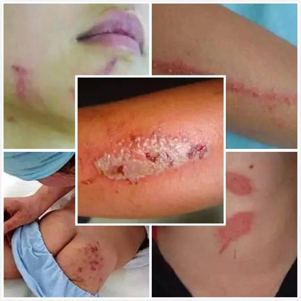 硫酸对皮肤的伤害图片