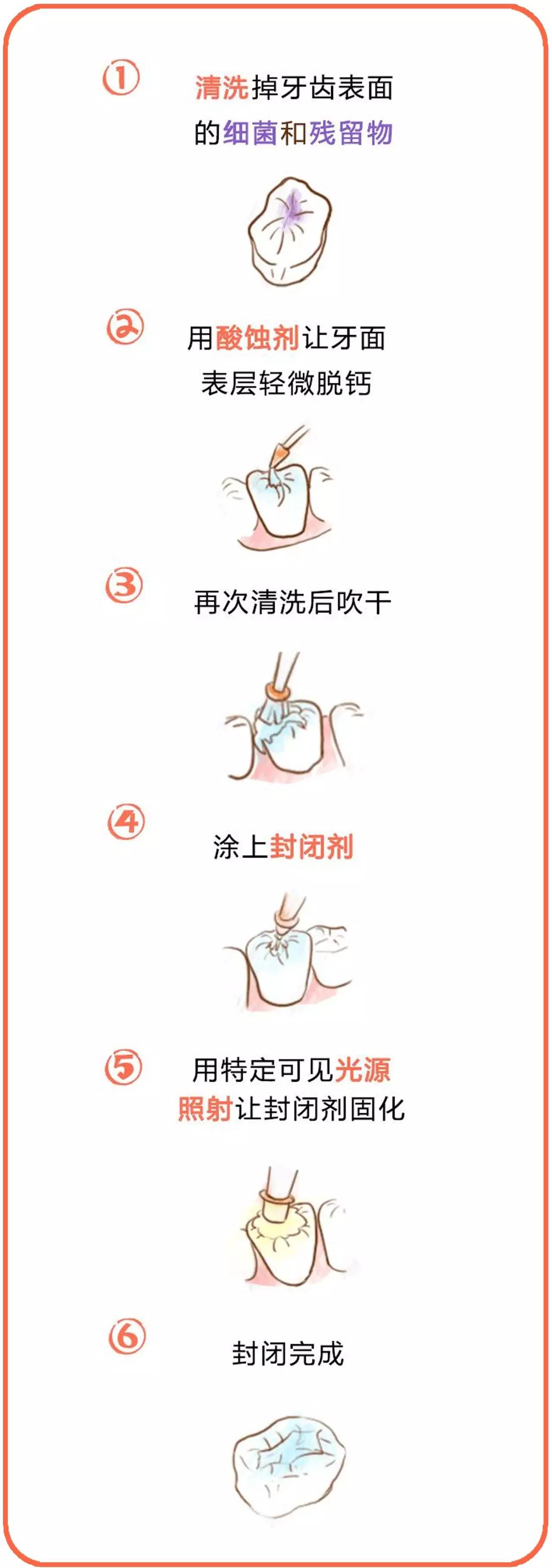 窝沟封闭步骤图图片