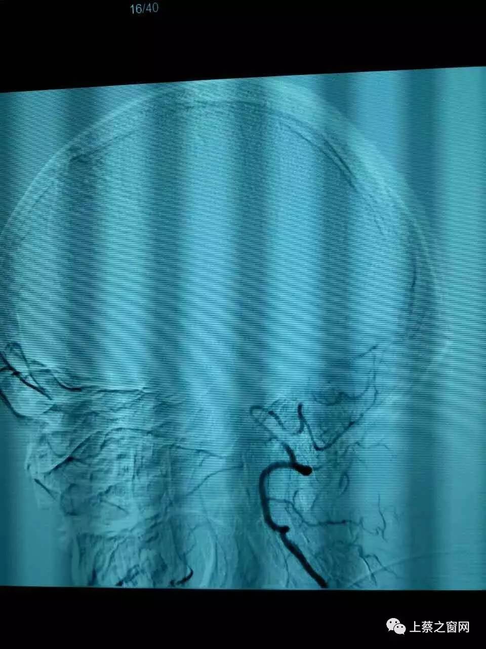 健康福音!上蔡縣中醫院成功開展主動脈弓 全腦血管造影dsa治療術